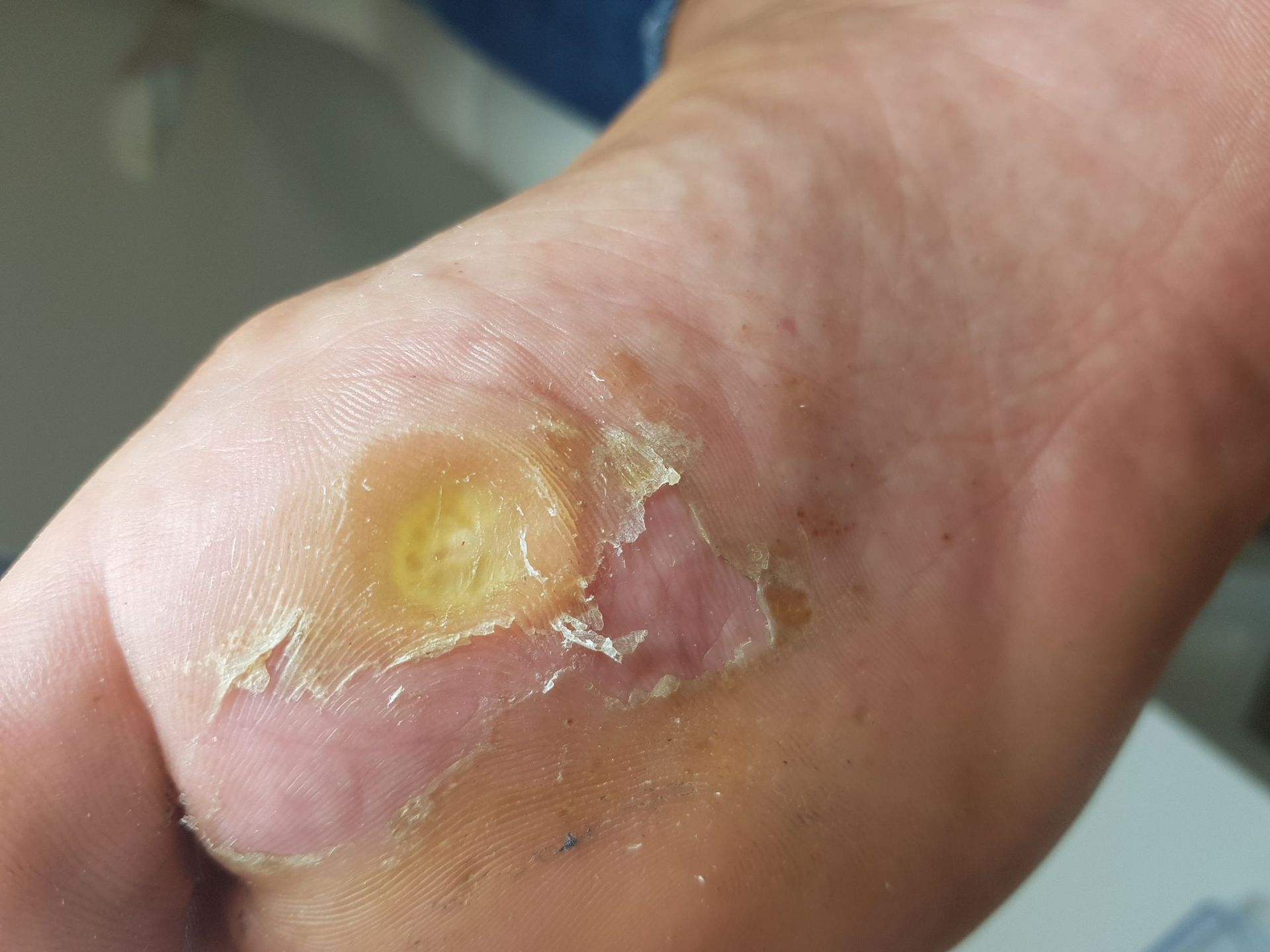 Hühneraugen Entfernung - Diana's Nagel Service - Baar