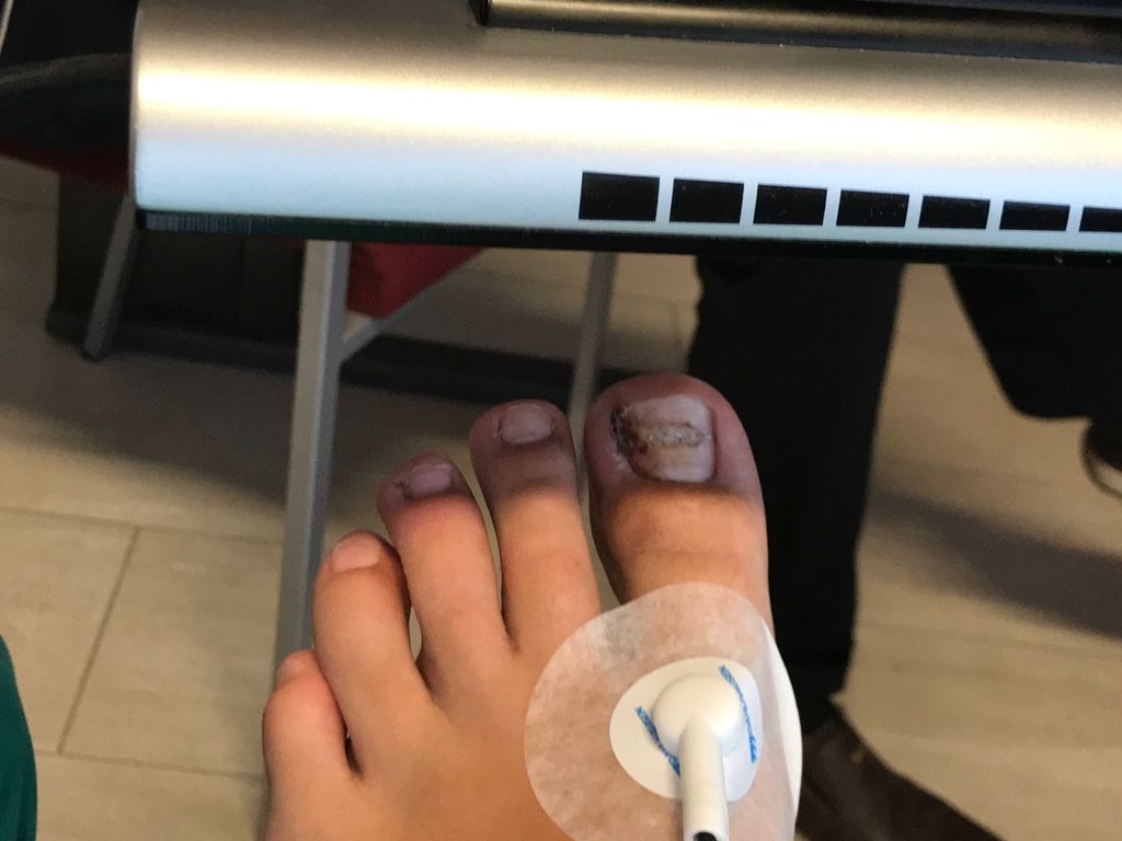 Eine Nahaufnahme des Fußes einer Person mit einer Nadel darin