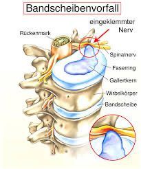 Ein Diagramm einer Bandscheibe im Rücken einer Person.