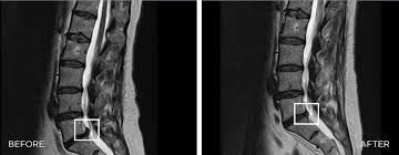 Ein Vorher-Nachher-Bild der Wirbelsäule einer Person.