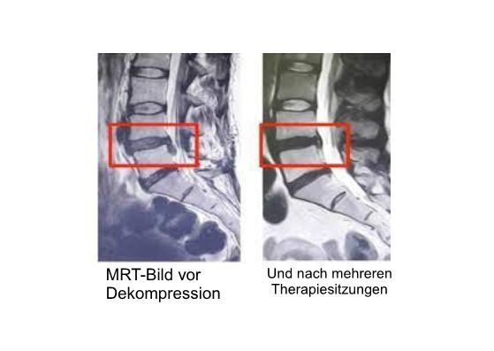 Ein Bild der Wirbelsäule einer Person mit den Worten „MRT-Bild vor Dekompression“ darauf