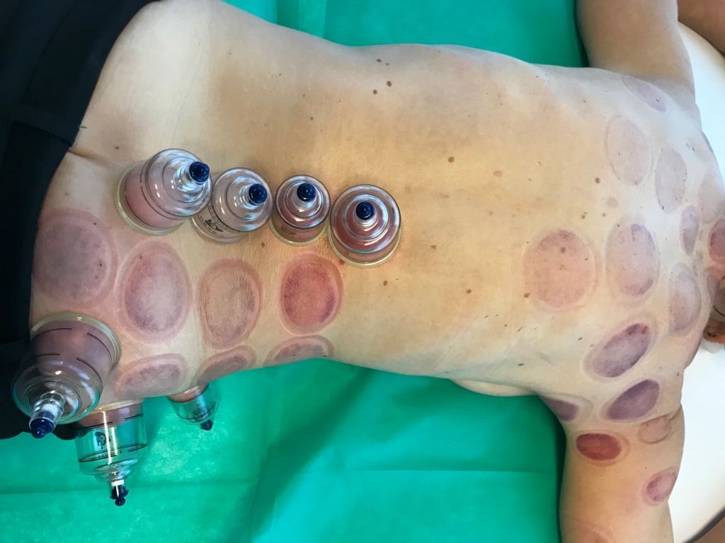 Eine Person liegt mit Schröpfköpfen auf dem Rücken auf einer grünen Decke.