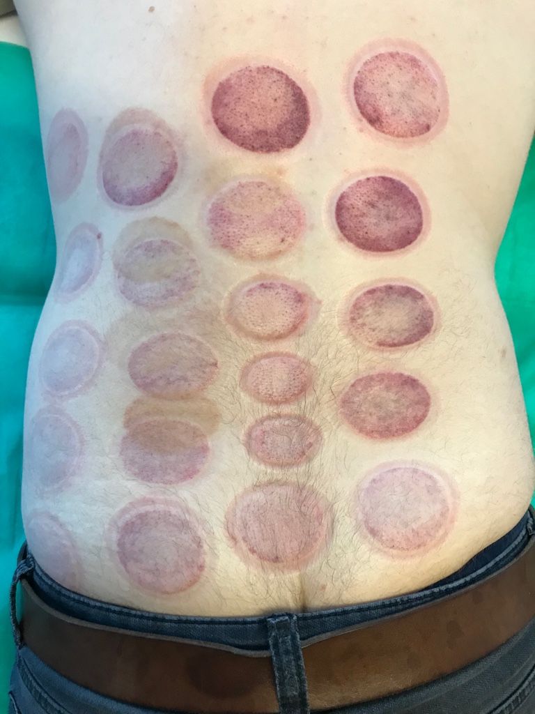 Der Rücken einer Person mit vielen Kreisen darauf.