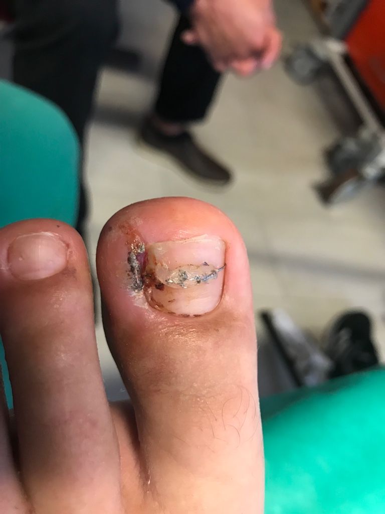 Eine Nahaufnahme des Zehs einer Person mit einer Zahnspange.