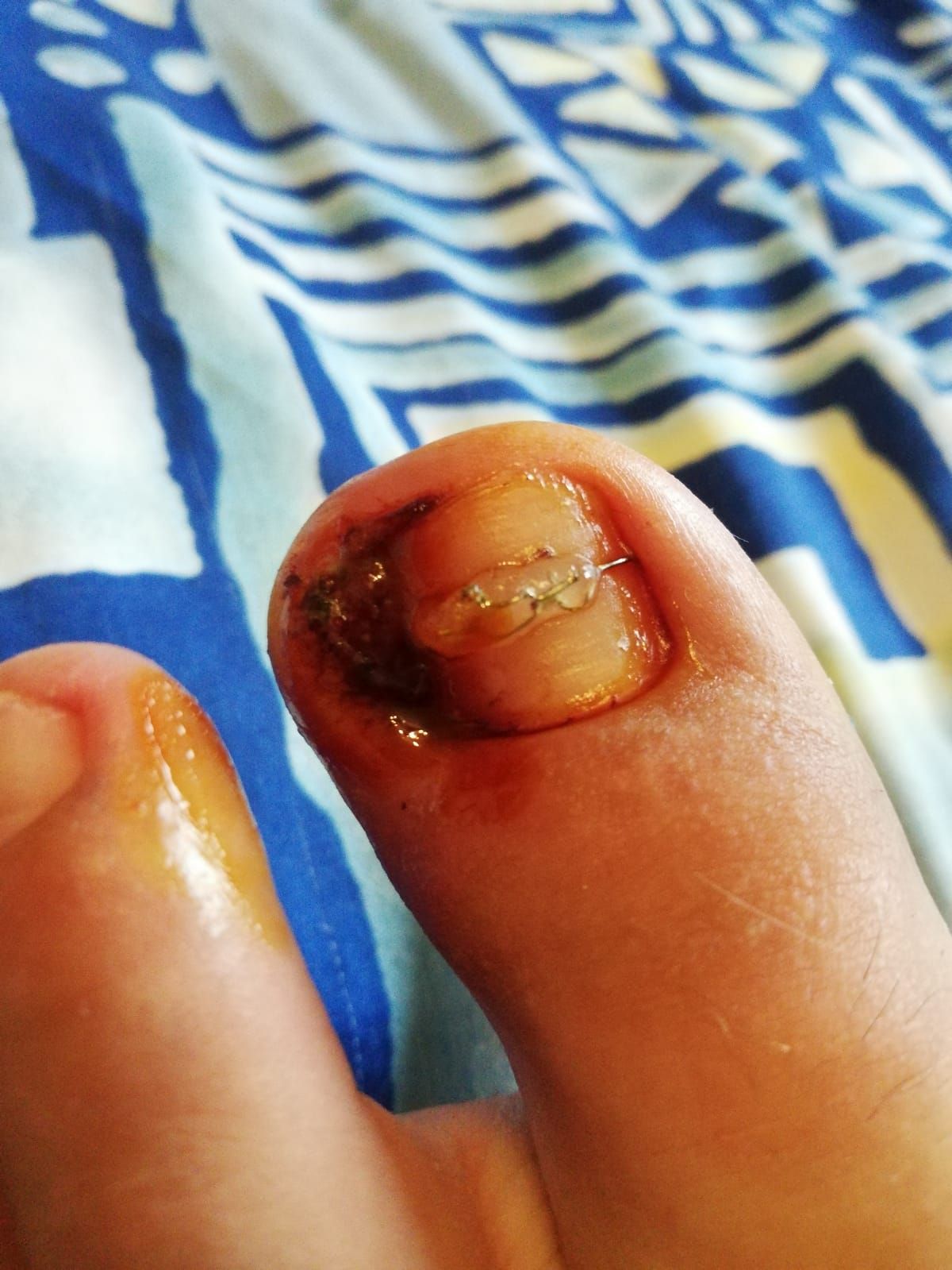 Eine Nahaufnahme eines Zehennagels einer Person mit einer Zahnspange