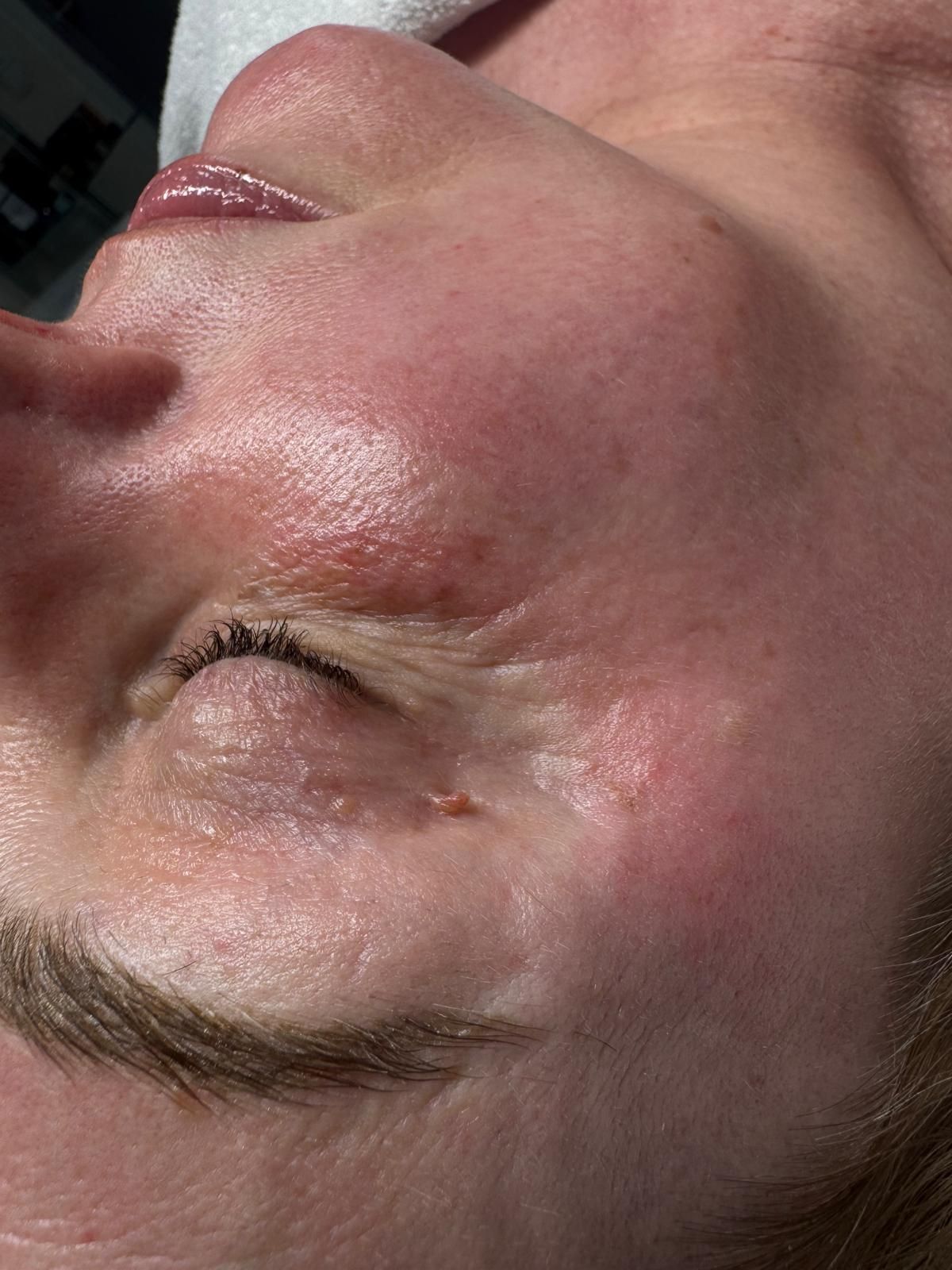 Nahaufnahme eines Gesichts mit einem geschlossenen Auge und einer geschwollenen, roten Stelle an der Wange.
