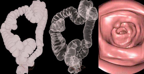 Coloscopie virtuelle