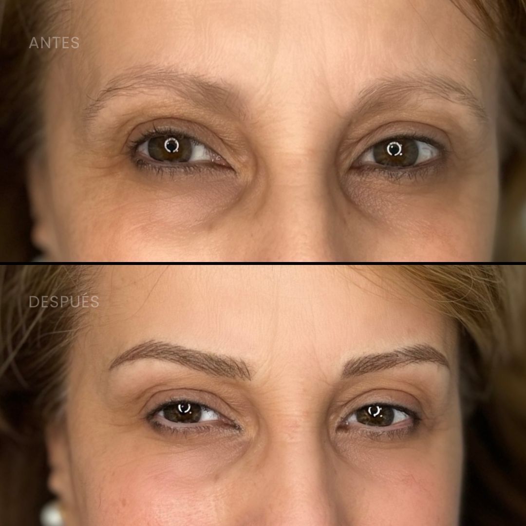 Antes y después de un procedimiento cosmético de cejas. La imagen superior muestra cejas dispersas; la inferior, cejas rellenas y perfiladas.