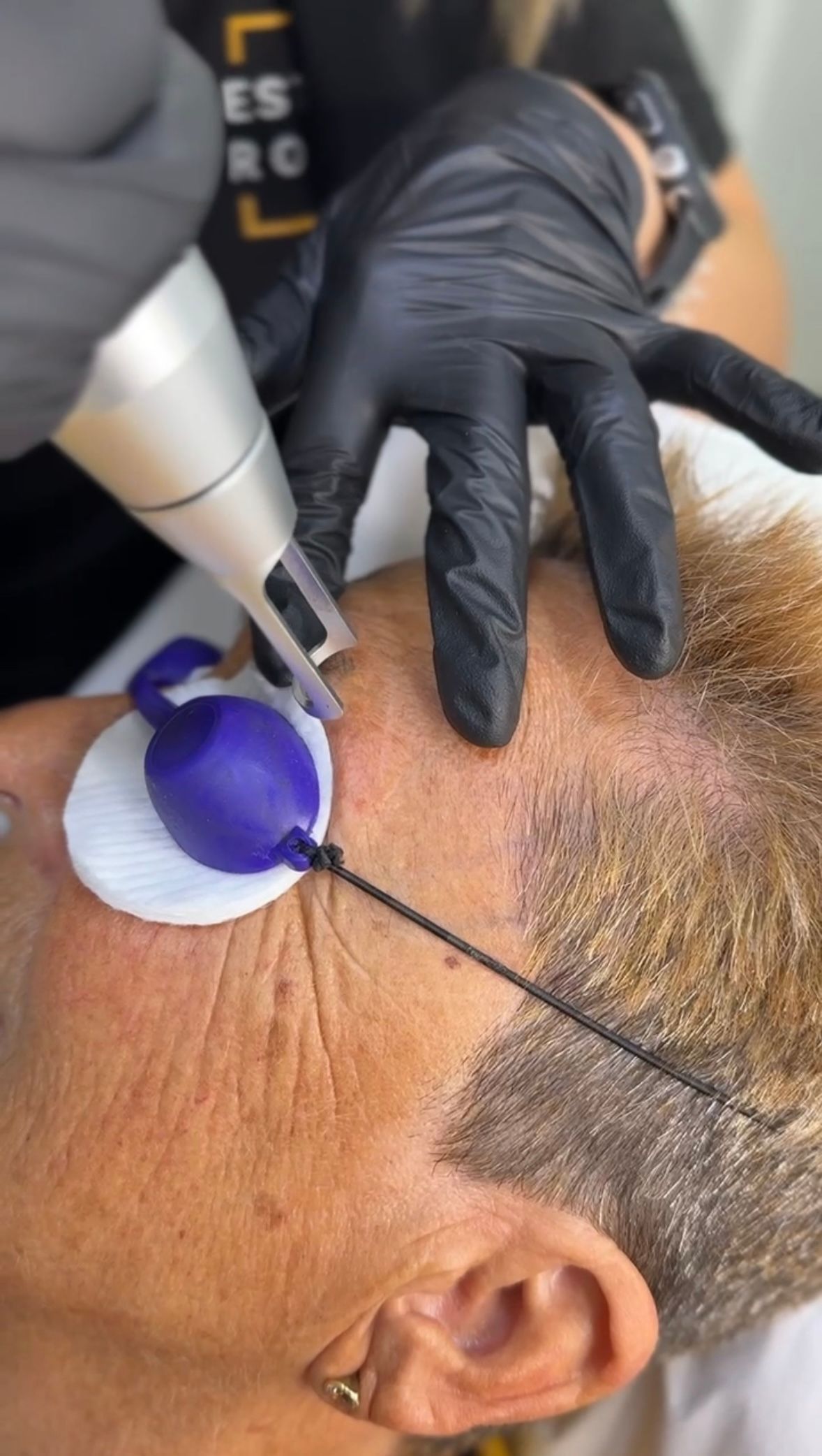 Persona que recibe tratamiento con láser en la cara, con protección para los ojos, manos enguantadas y en entorno interior.