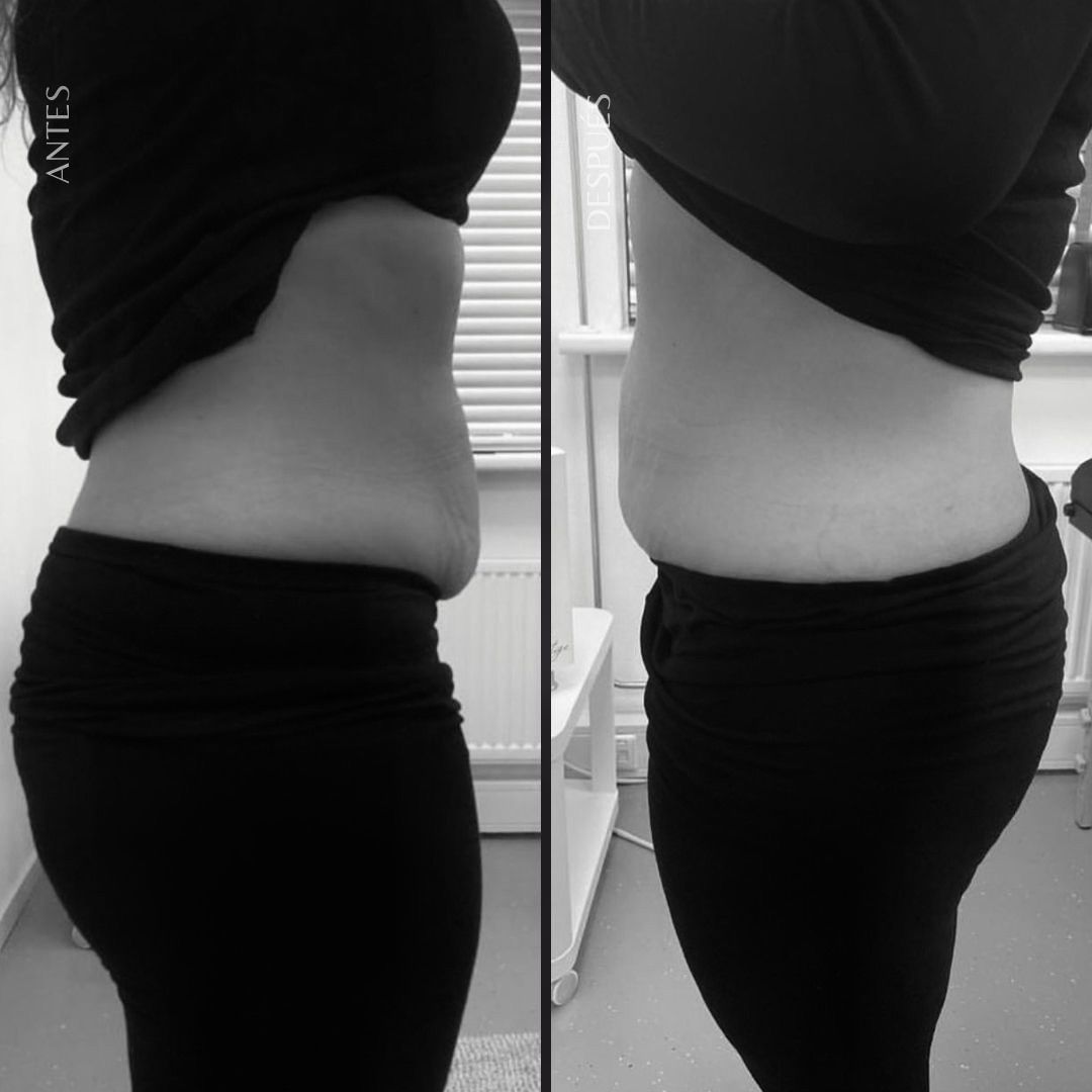 Comparación del cuerpo de una persona vestida de negro, lado a lado, antes y después de un tratamiento, probablemente para perder peso.