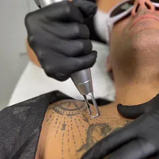 Un hombre se está quitando un tatuaje del pecho.