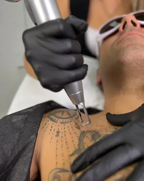 Un hombre se está quitando un tatuaje del hombro.