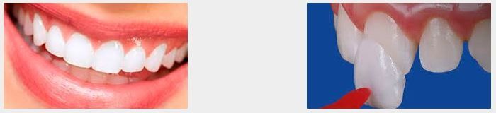 Boca sonriente con dientes blancos y primer plano de un diente sobre fondo azul.