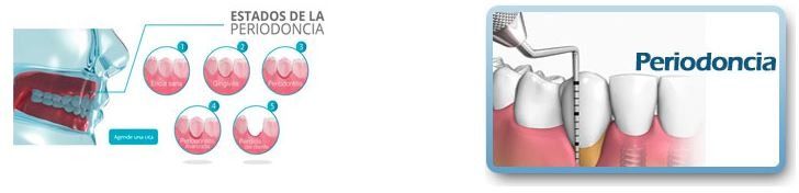 Salud dental visual: etapas de la periodoncia; ilustración de limpieza de dientes.