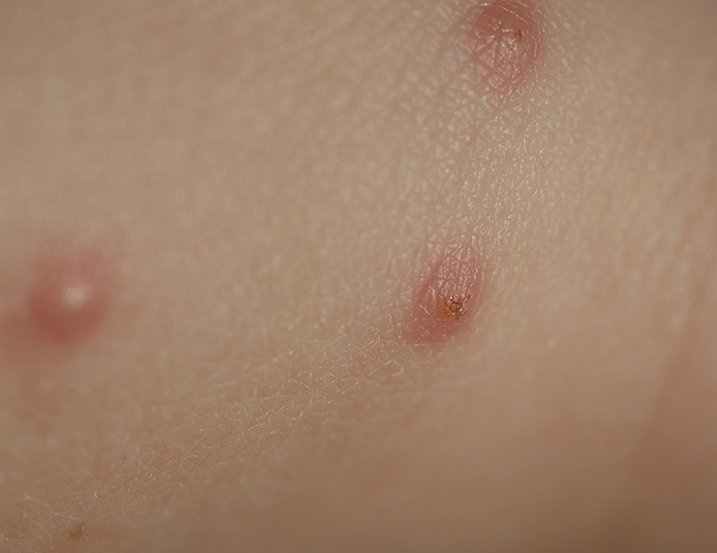 Piqûres de punaise de lit