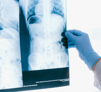 Médico com luvas azuis examina uma radiografia de tórax.