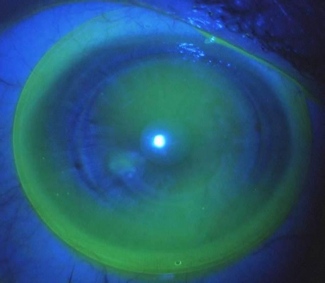 Lentille cornéo-sclérale