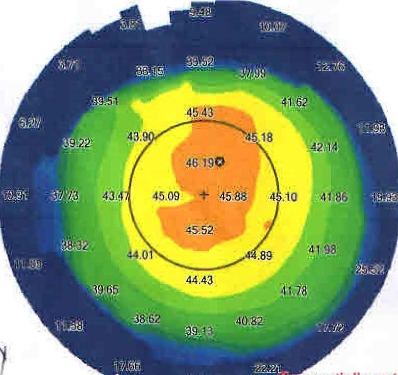 Avant ortho-kératologie