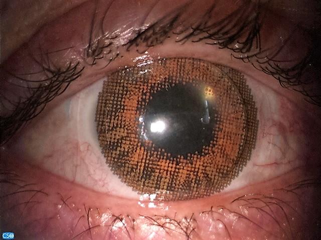 Lentille esthétique