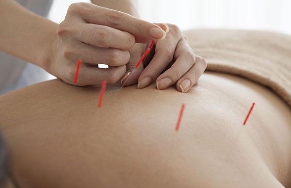 Manos realizando acupuntura en una espalda desnuda con finas agujas rojas insertadas.