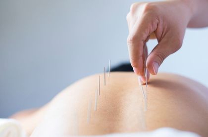 Una persona recibe acupuntura en la espalda; agujas insertadas con la mano.
