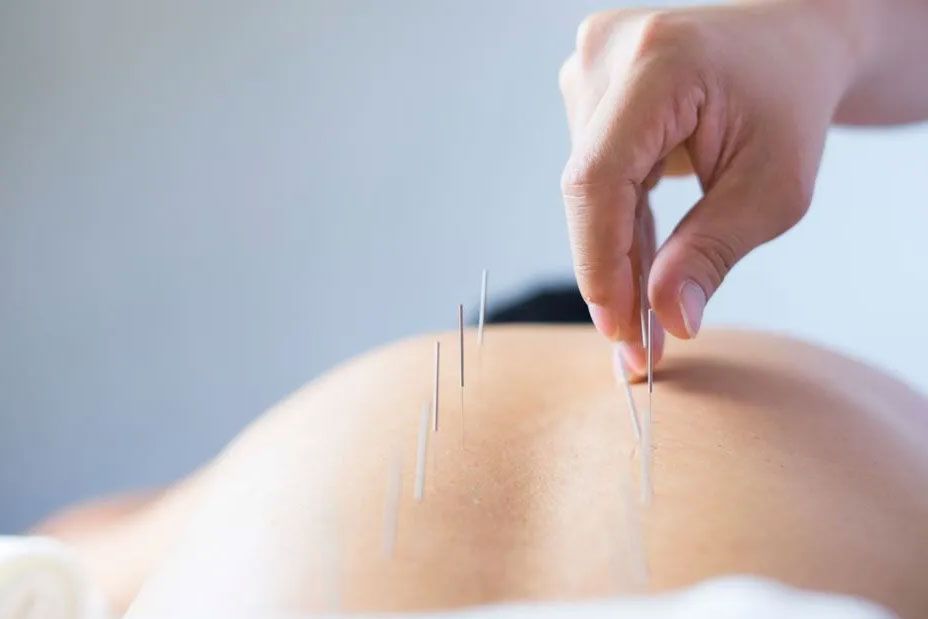 Una mano coloca agujas de acupuntura en la espalda desnuda de una persona.