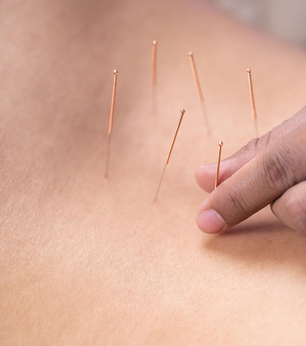 Agujas de acupuntura insertadas en la piel mientras una mano ajusta una aguja
