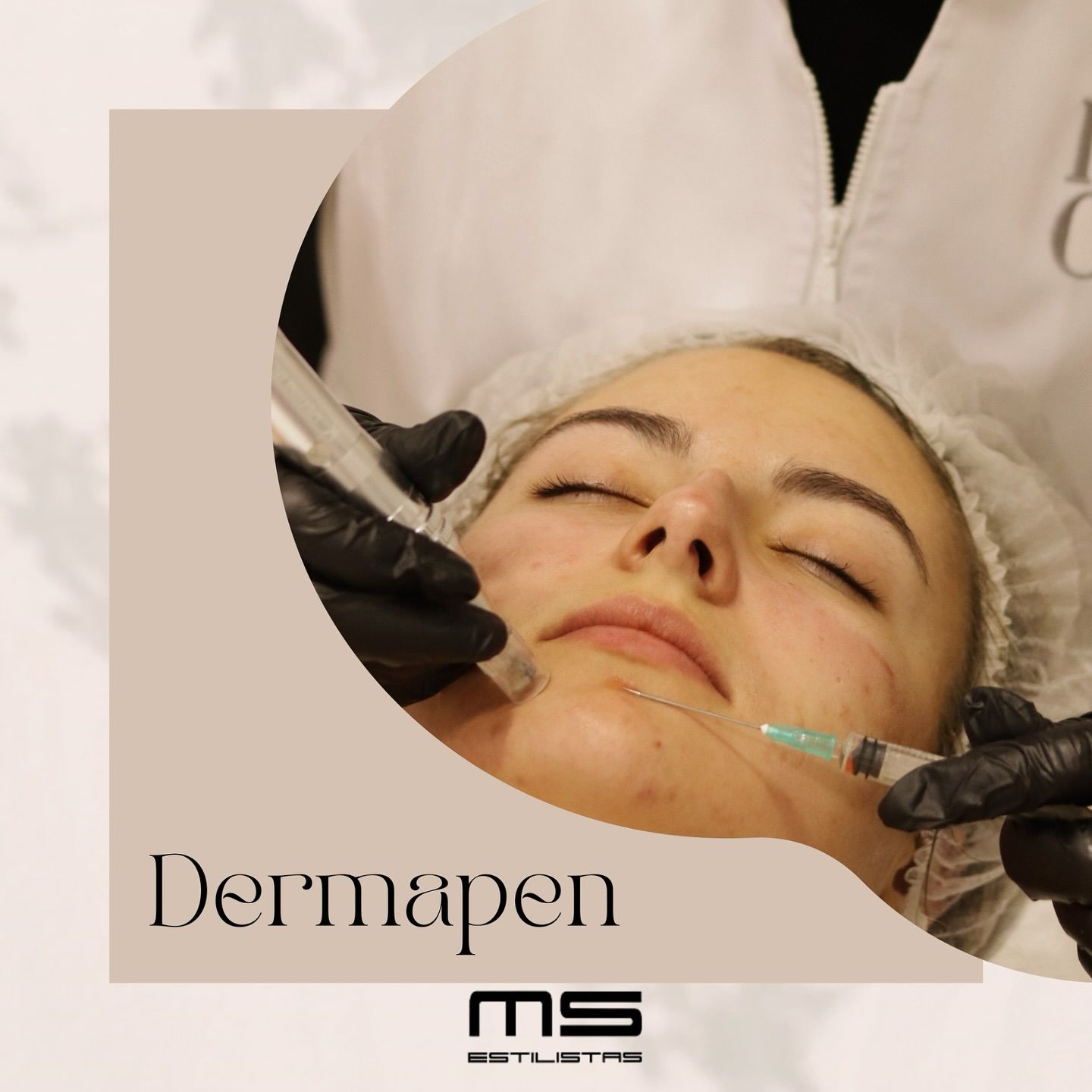 Una mujer está recibiendo un tratamiento con Dermapen en su cara.