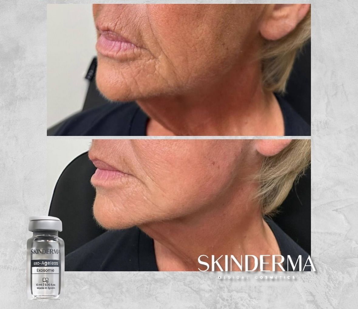 Una foto de antes y después del rostro y el cuello de una mujer por Skinderma.