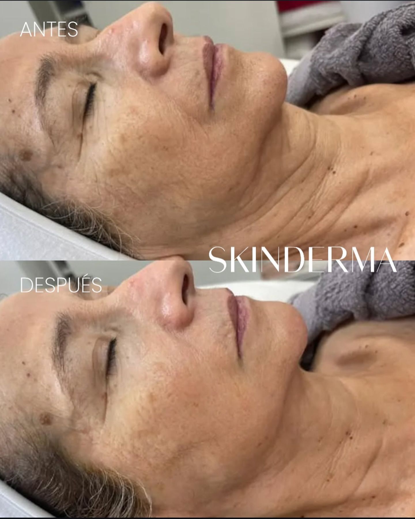 Una fotografía de antes y después del rostro de una mujer.