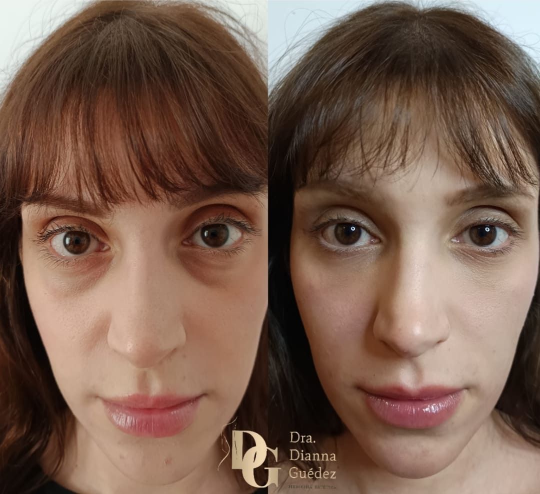 Una foto de antes y después del rostro de una mujer.
