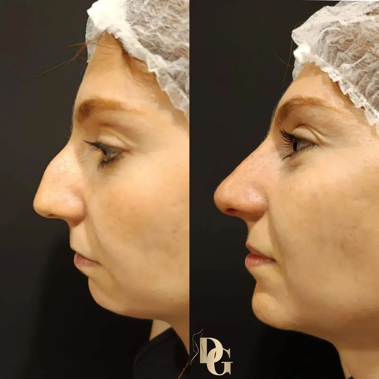Una foto de antes y después de la nariz de una mujer.