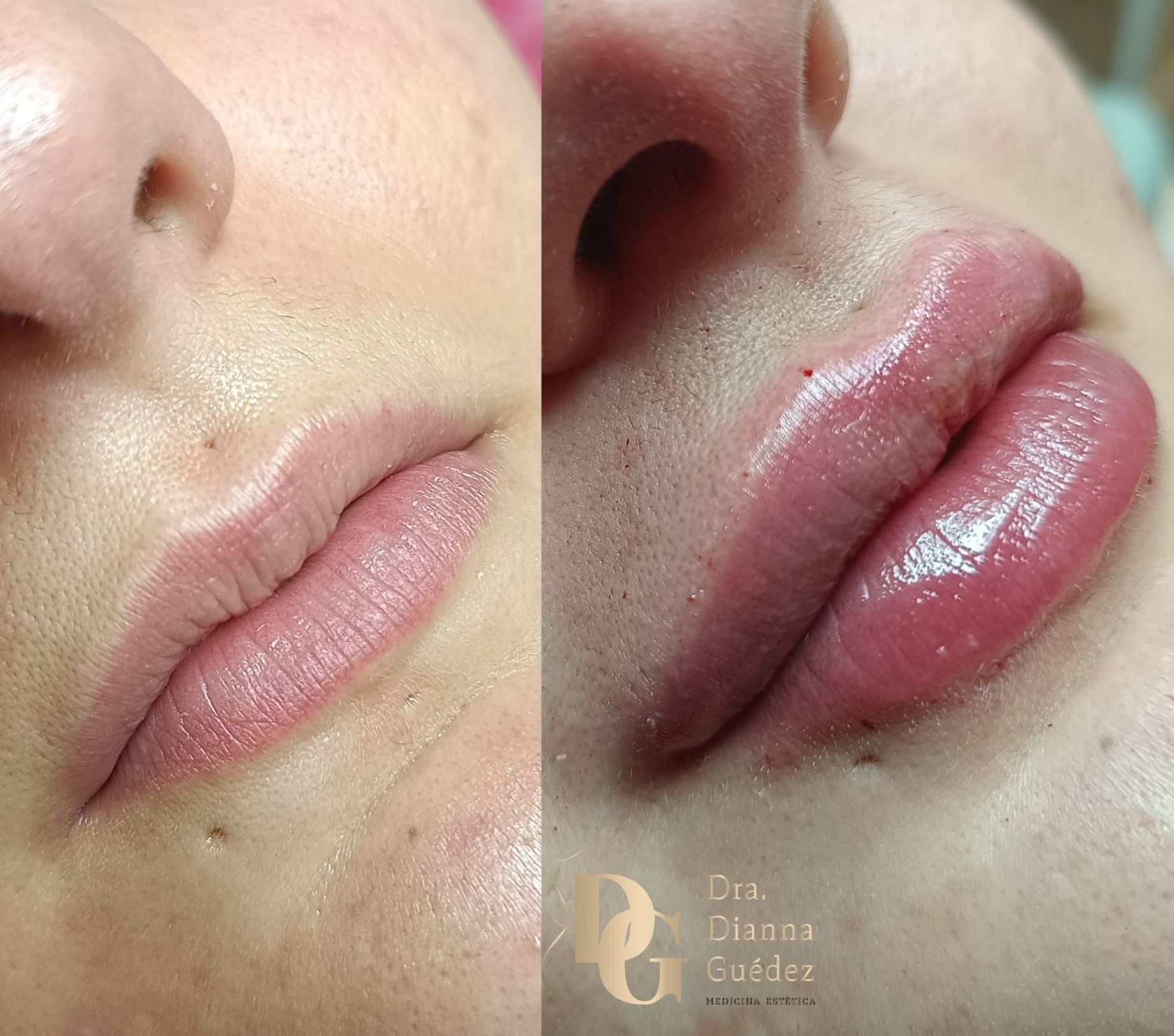 Una foto de antes y después de los labios de una mujer con la Dra. Diana Cuadra escrita en la parte inferior.