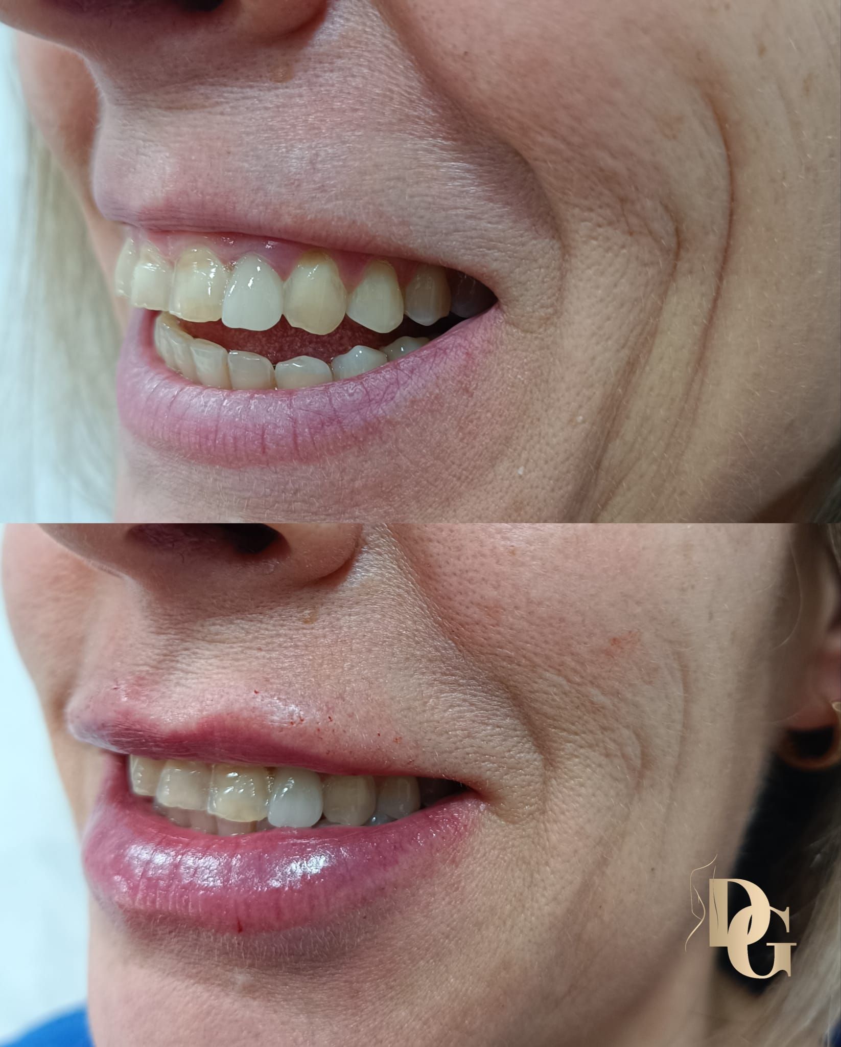 Una foto de antes y después de la boca y los dientes de una mujer.