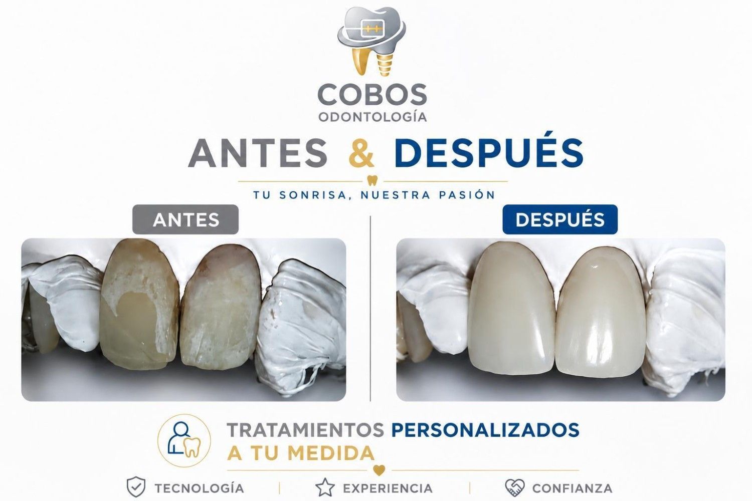 Primer plano de una hilera de dientes de plástico blancos y beige o muestras dentales sobre una bandeja gris.