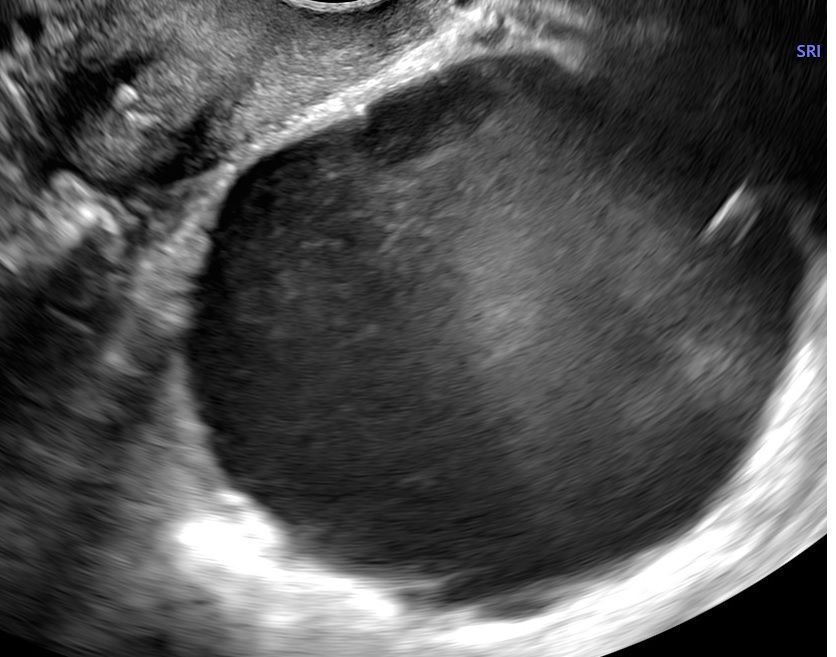Voiko Se Olla Endometrioosi 