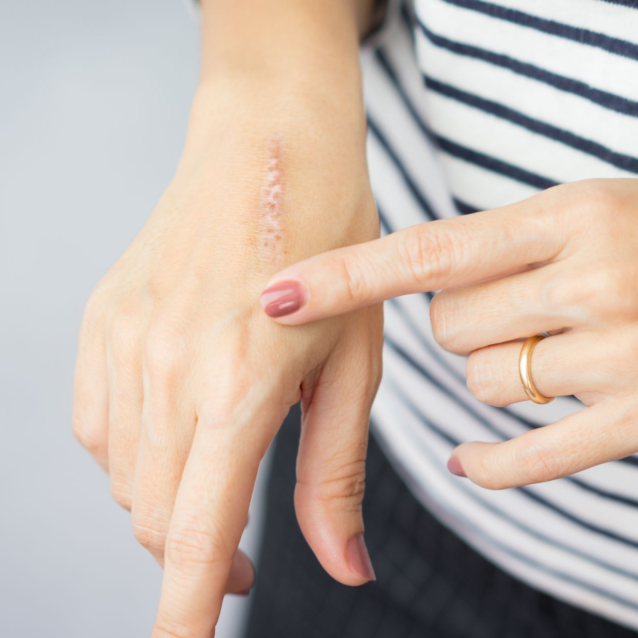 Femme montrant une cicatrice