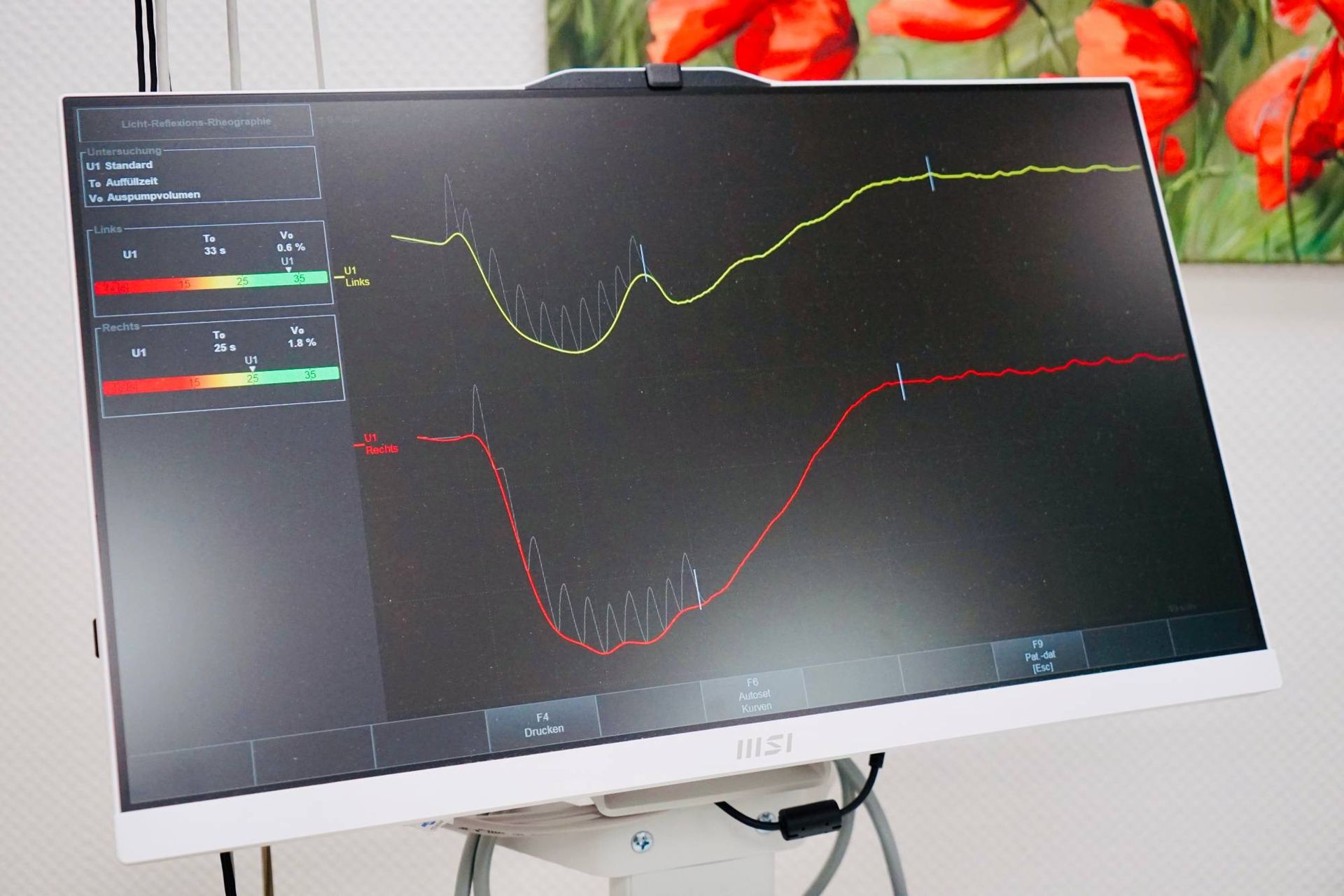 Auf dem Monitor werden zwei schwankende Diagramme angezeigt, eines gelb und eines rot, wahrscheinlich medizinische Daten.