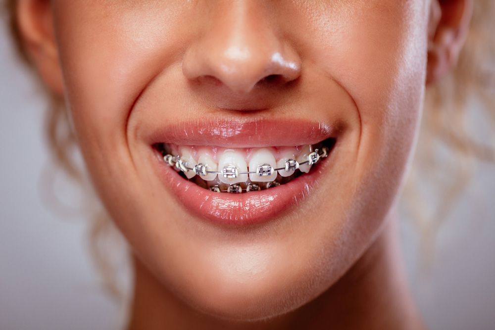 Un primer plano de la boca de una mujer con aparatos dentales.