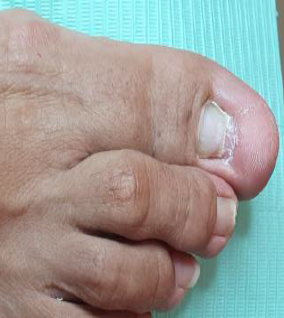 Primer plano de un pie humano con la uña del dedo gordo agrietada y descamada. La piel es de color marrón claro.