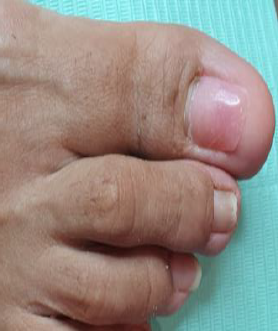 Primer plano de un pie, con especial atención a los dedos. La uña del dedo gordo está ligeramente rosada.