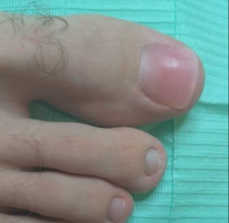 Primer plano de un pie con el dedo gordo hinchado y enrojecido. Se ven los demás dedos.