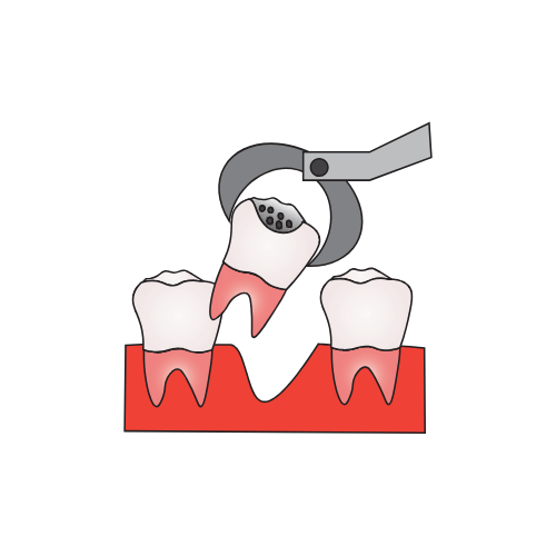 خلع الاسنان