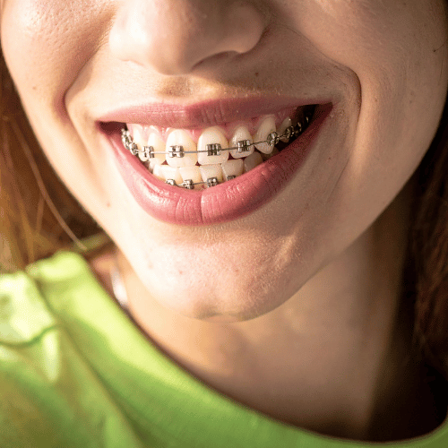 تقويم أسنان في المقابلين
