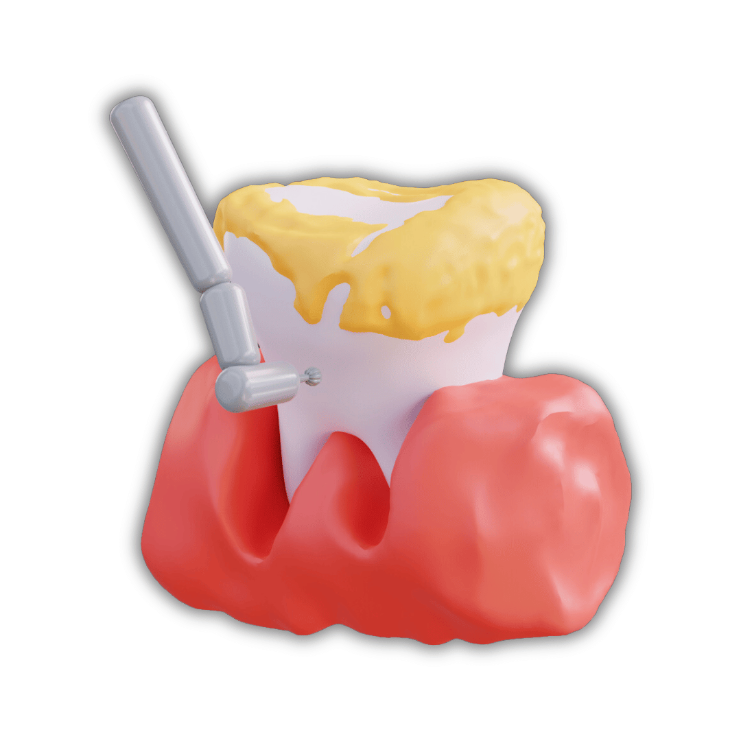 تنظيف أسنان المقابلين
