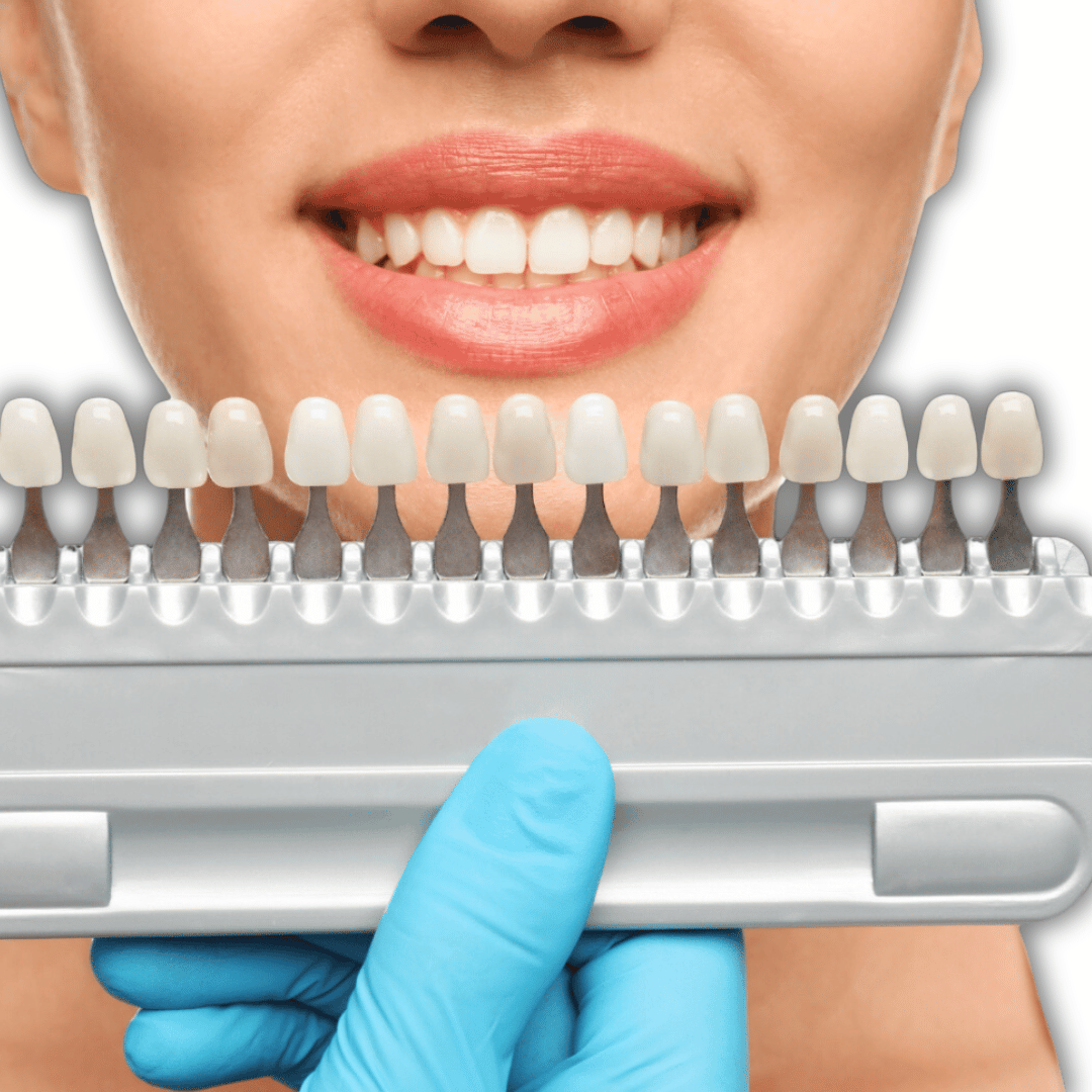 فينير أسنان في المقابلين