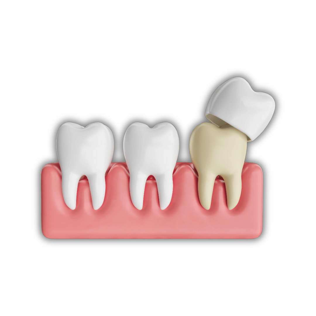 تيجان وجسور الأسنان