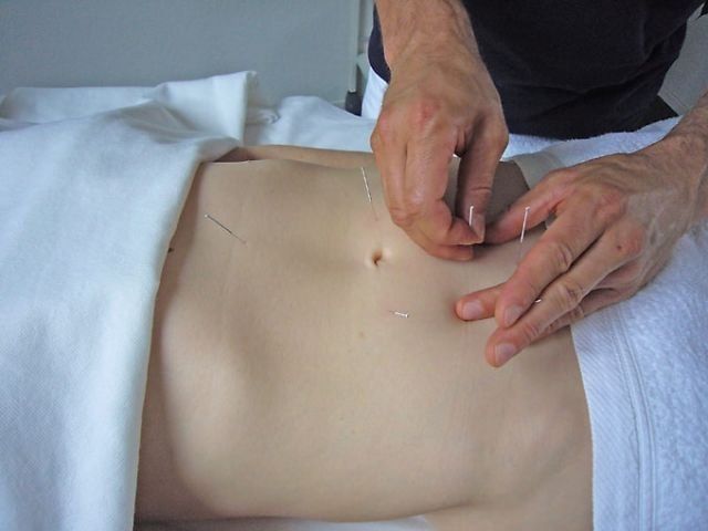 Frau bekommt eine Bauch-Akupunktur
