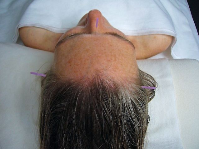 Frau bekommt eine Kopf-Akupunktur