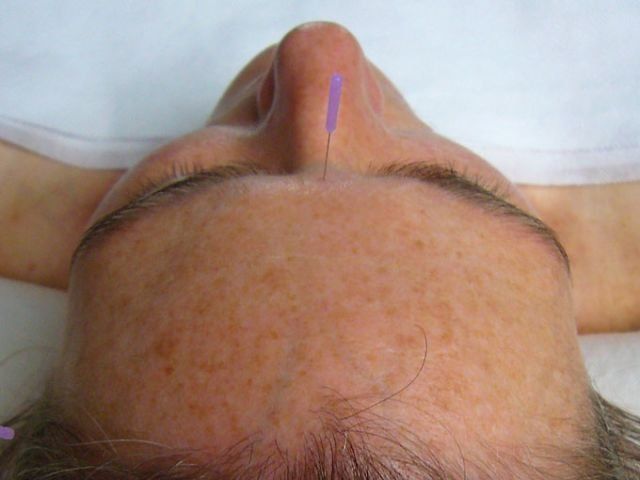 Frau bekommt eine Kopf-Akupunktur